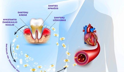 Periodontitas