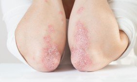 Žvynelinė psoriazė gydymas