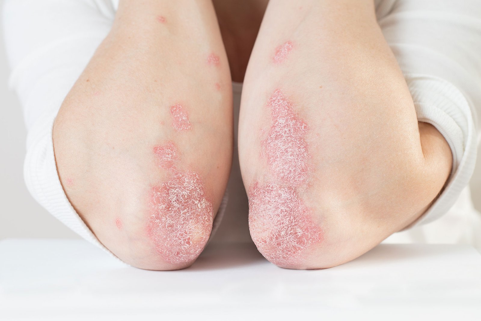 Žvynelinė psoriazė gydymas