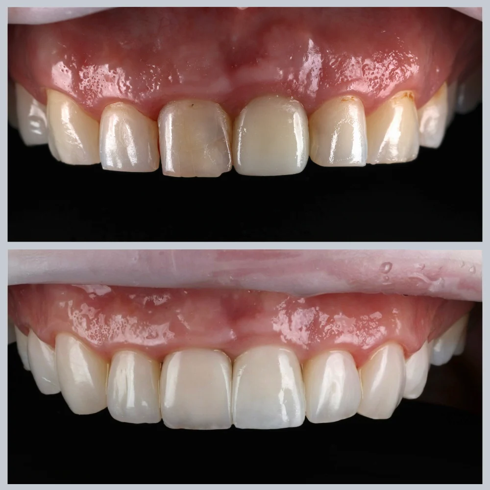 Dantenų ligos prieš ir po