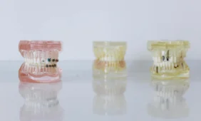 Dantų implantų kaina