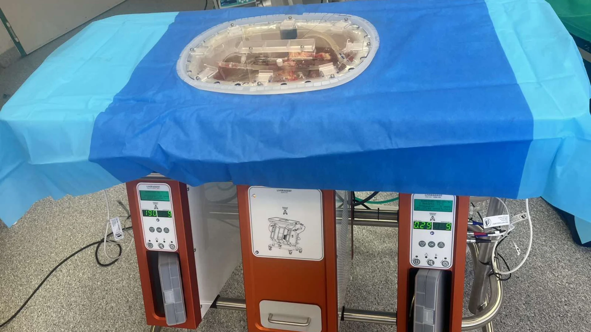 Kepenų translpantacija