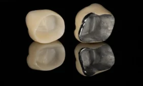 Metalo keramijos vainikėlis