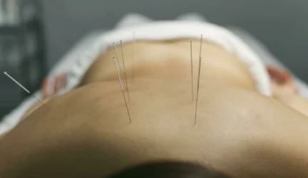 Akupunktūra