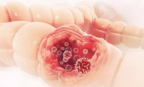 Storosios žarnos vėžys