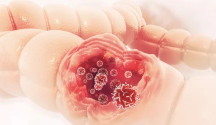 Storosios žarnos vėžys