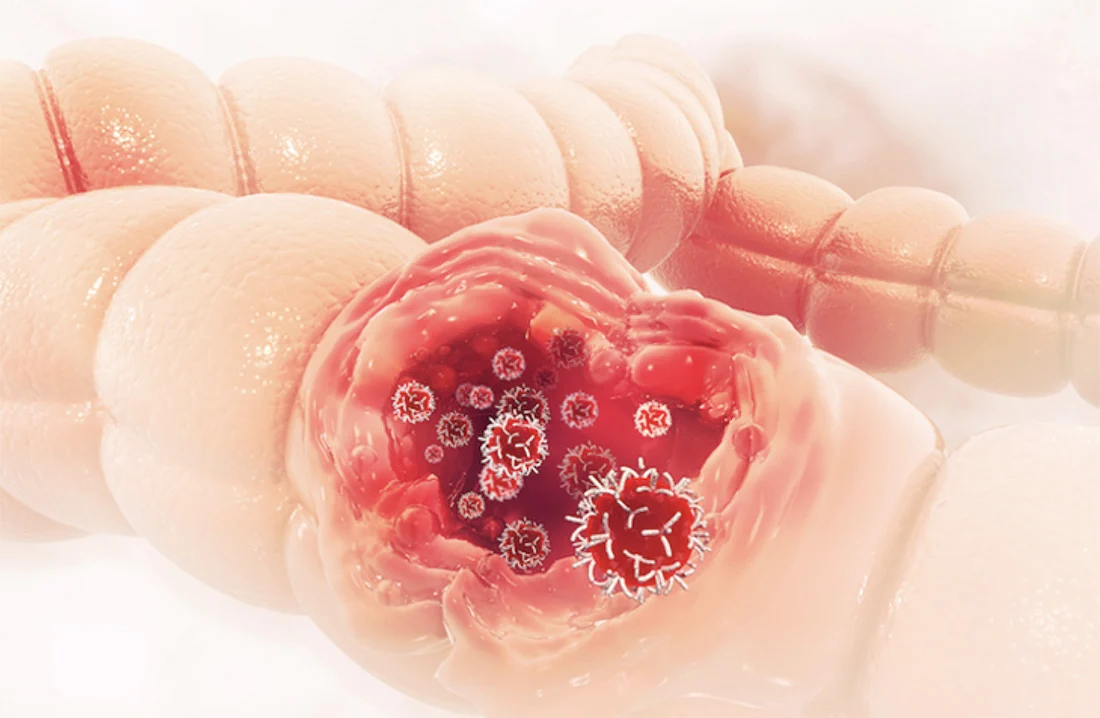 Storosios žarnos vėžys