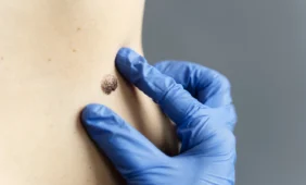 Apgamų šalinimas lazeriu