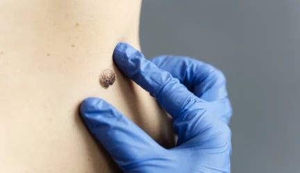 Apgamų šalinimas lazeriu