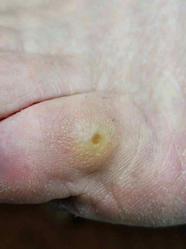 Gilios pėdų nuospaudos gydymas