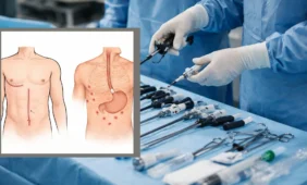 stemplės ir skrandžio vėžio operacija