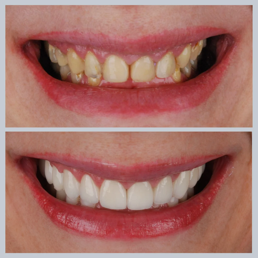 Periodontitas prieš ir po