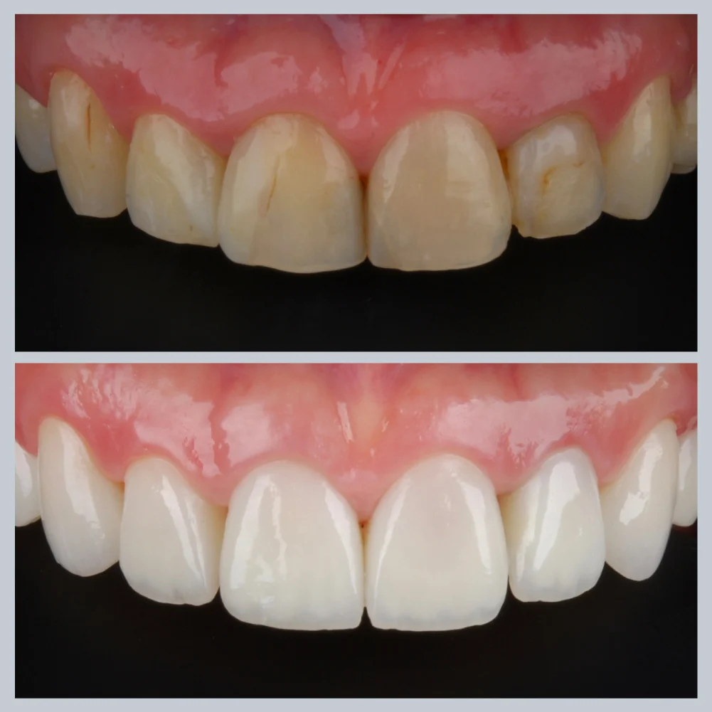 Dantenų uždegimas prieš ir po