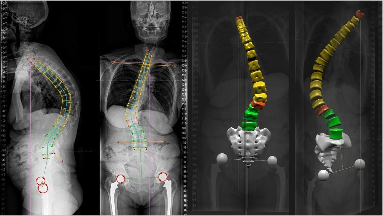Spinalinė chirurgija
